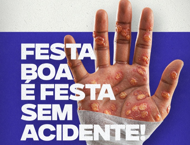 Prefeitura divulga campanha de conscientizao sobre risco de queimaduras durante festas juninas
